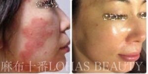 麻布十番グリーンピール皮膚炎・敏感肌・アレルギーLOHAS BEAUTYビフォーアフター「東京ハーブピーリング」